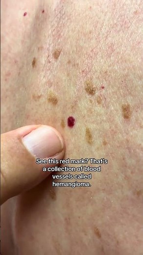Dermatologist with 50 years experience shows how to tell what different spots are on patient's back