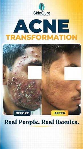 Acne Transformation You Need to See! 😲 | Before & After | ‪@skinqure‬