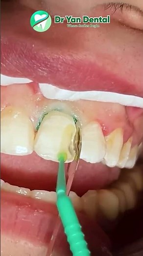 Fixing Front Teeth Flawlessly with Advanced Composite Technique#CompositeRestoration