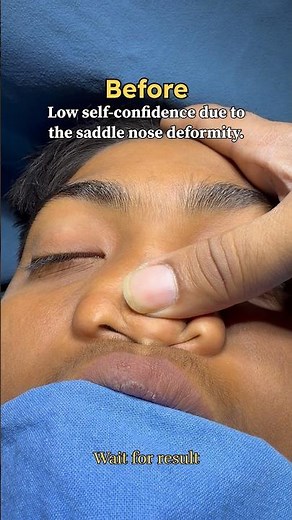 #rhinoplasty #bestrhinoplasty saddle nose deformity correction