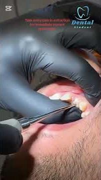 Extraction of upper anterior remaining root #dentist #dentistry