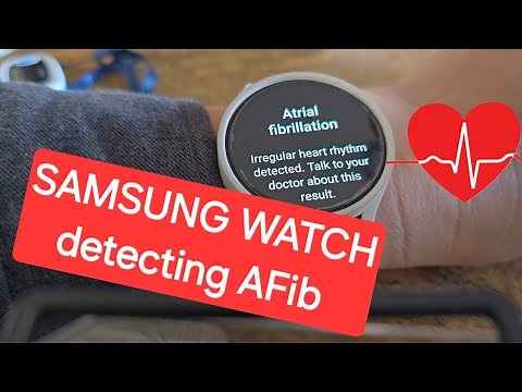 Samsung Smart watch detects Atrial fibrillation in 30 seconds - AFib irregular heartbeat