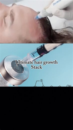 The ultimate Hair growth stack. ⚡️ Microneedling. ✔️ Biotin Injections ✔️ @obagiuk Scalp serum ✔️ Whether you suffer from hair loss or just want the ‘omg I love your hair’ compliments. You NEED this treatment plan in your life. 👸🏻 For men and women 💥 #hairgrowthjourney #hairtransplant #aeathetics #hairhacks #princesshair