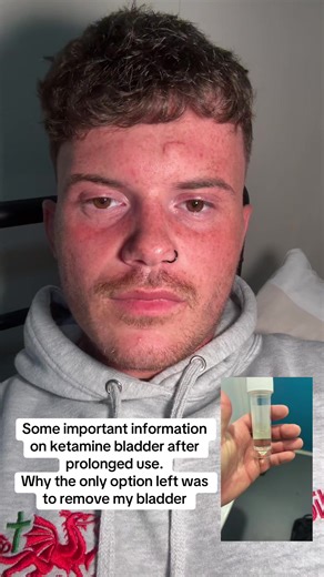 Ketamine Bladder Damage: My Surgical Journey