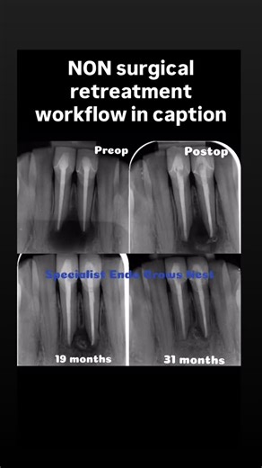 1. Local anaesthetic and rubber dam 2. Removal of GP using ProTaper universal Shapers 3.Medication of canals Ultracal 4. Temporise 4 weeks Cavit base and GIC 5. Prep F2 protaper ultimate 6. Activation of irrigants endoactivator 7. MTA ProoRoot plug back filled GP 8. SDR BASE composite in access #savingteeth #rootcanaltreatment #BackFill #ProRootMTA | Specialist Endo Sydney- Clinical hacks