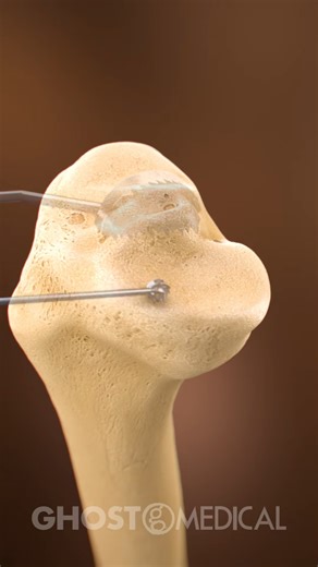 124K views · 352 reactions | Ghost Medical Animation, in...