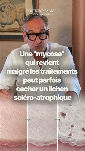 Mycose à répétition : et si c’était un lichen scléro-atrophique ?