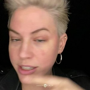 PDO Thread Brow Lift using NovaThreads (Patient Experience)