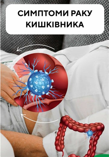Рак кишківника: важливість ранньої діагностики