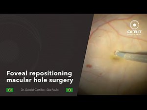 Foveal repositioning macular hole surgery
