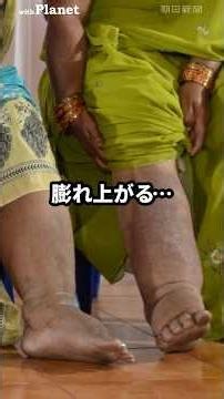 What is Lymphatic Filariasis, the Disease That Causes Limbs to Swell Like an Elephant's?