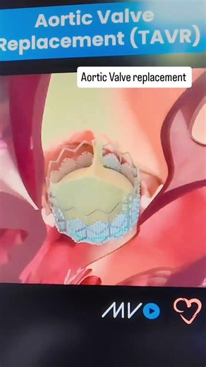 Aortic Valve replacement #anatomy #ultrasound #reels #medicosstuff #nurse #doctor