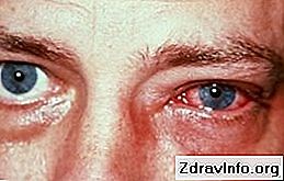 Episkleritída oka: príznaky, typy ochorení, jej diagnóza a metódy liečby 👃👃 Portál Sínus A Ďalšie. - 2025