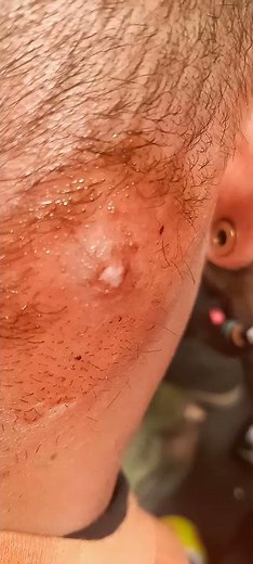 3 day old spider bite before she pops it for me!!