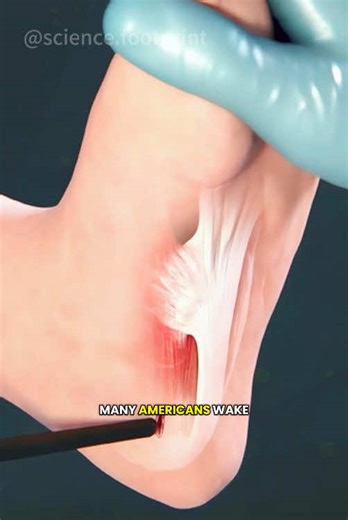 Understanding Planter Fascia Release Surgery