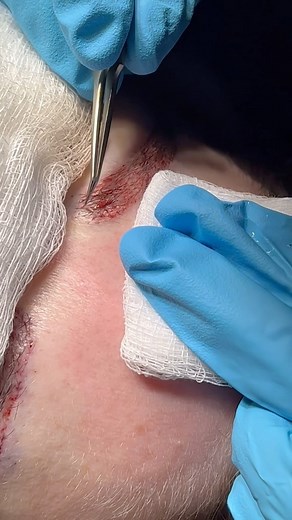 Jason Champagne, M.D. on Instagram: "Take an inside peek at my #ChampagneBrows procedure in action. Here’s a simple reel showing the precise and methodical placement of follicles, a key step in the transformation process. . . #eyebrowhairtransplant #eyebrowtransplant #browtransplant #eyebrowexpert"