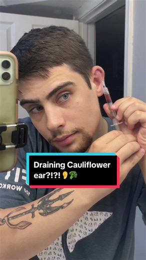 Draining Cauliflower Ear: Step-by-Step Guide