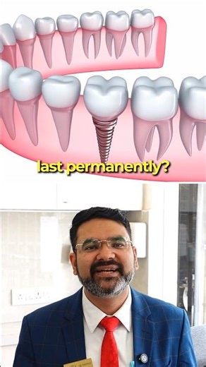 Do Dental Implants last permanently | Dental Implants Durability explained | Titanium Implants