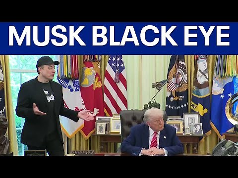 Elon Musk's black eye: Here's how he said he got it