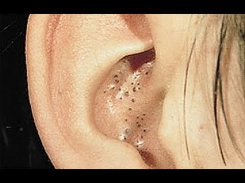 How to Get Rid of Blackheads in Your Ears