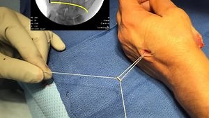 Thumb CMC Arthroplasty with Rope Device
