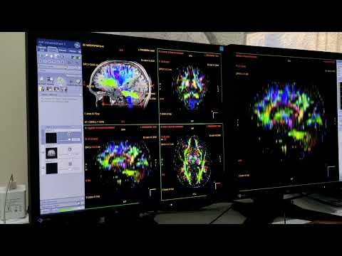 DTI (DIFFUSION TENSOR IMAGING) # POST PROCESSING # MRI BRAIN 🧠#GE 1.5T HDXT 16 Channel