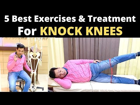 Knock Knee Treatment, Genu Valgum, knock knees correction exercise, How to treat knock knees