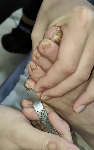 5.3K views · 28 reactions | Cleaning nail  #salon #nails #toenail #ingrowntoenail #tutorial | Ingrown Toenails | Facebook