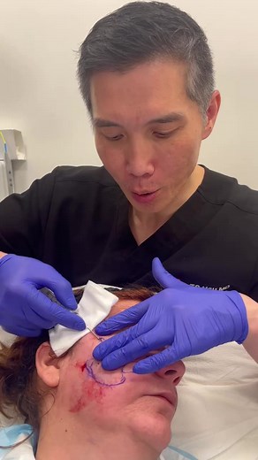 Watch as Dr. Hsu performs a subcision treatment for acne scarring! ...