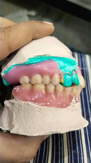 Upper Removable Partial Denture Ready For Flasking 😁😁😁#rpddentalprocedure#viralvideo