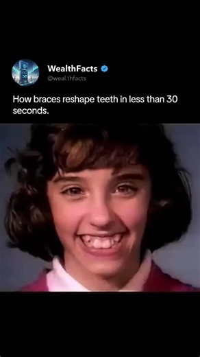 WealthFacts | Magic or Science? 🤯 See Braces 'Reshape' Teeth in 30 Secs! The REAL secret behind braces! 🤯 This incredible time-lapse shows the final... | Instagram