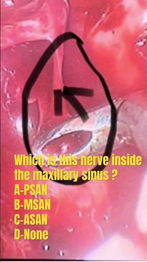 MCQ-SUPERIOR ALVEOLAR NERVE
