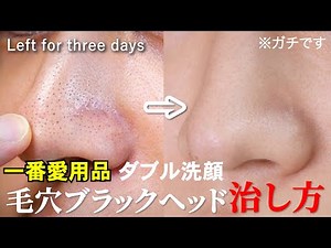 【角栓・いちご鼻必見】ガン詰まり毛穴も一発で治す！一番愛用してるブラックヘッド除去方法 Blackheads oilpulling