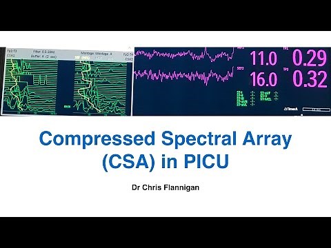 Compressed Spectral Array (CSA) use in PICU