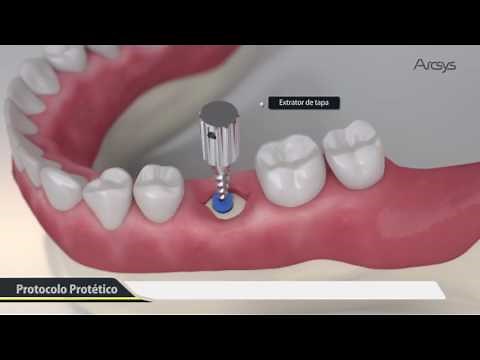 Procedimento Cirúrgico 3D - Arcsys Sistema de Implantes | FGM