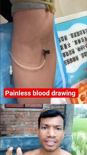 Mastering Painless Blood Draws with Butterfly Needle