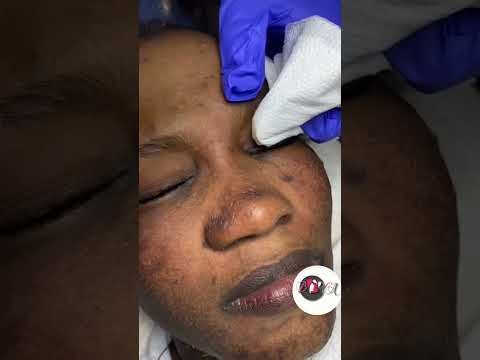 Extracción de Acné Profunda | Limpieza de Poros Negros Oscuros - Blackheads Removal