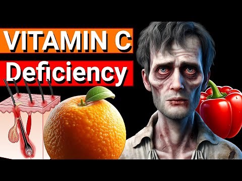 Vitamin C Deficiency symptoms. Prevention and treatment