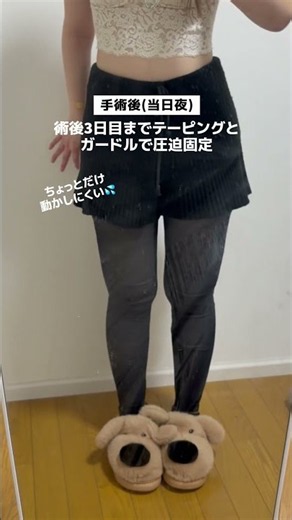 【脂肪豊胸】太もも後面から脂肪を採取✍️1ヶ月のダウンタイム #脂肪豊胸 #脂肪豊胸 #ダウンタイム #湘南美容クリニック横浜東口院