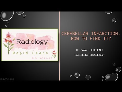 09_Brain_Cerebellar Infarction