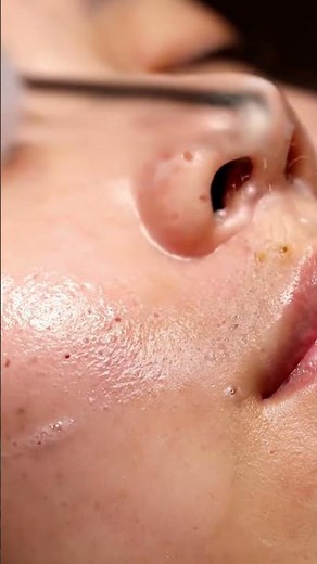 Deep Pore Cleansing ASMR | Gentle Blackhead & Whitehead Extraction with Suction Tool | Relaxing Spa.