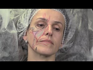 Facial Topographic Anatomy for Filler Injectors