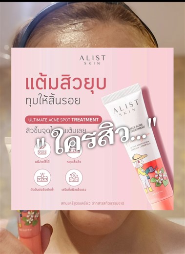 #สิวหน้าผาก #รักษาสิว #รีวิวจริง #ผิวใส #เทรนด์วันนี้มาแรงอันดับ1