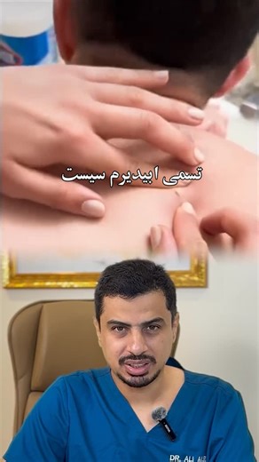 ‎د.علي العيد‎ on Instagram‎: "كيس … epidermal cyst …. في منطقة الظهر #دكتور_علي_العيد #جلدية #تجميل #الرياض #عناية_بالبشرة #السعودية #عناية"‎