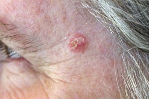 How to recognise actinic keratosis | Emergency Live