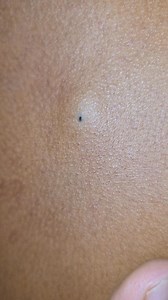 Sebaceous cyst | Dr Khaled's Tumour Helpline