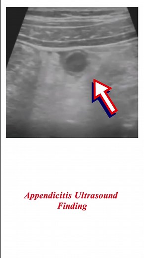 Ultrasound Findings in Acute Appendicitis Diagnosis