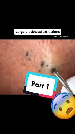 Effective Large Blackhead Extraction Techniques