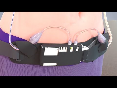 Revolutionary Drain System Transforms Breast Cancer Recovery (3D Animation)