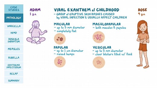 Video: Viral exanthems of childhood: Pathology review - Video Explanation! | Osmosis | Osmosis